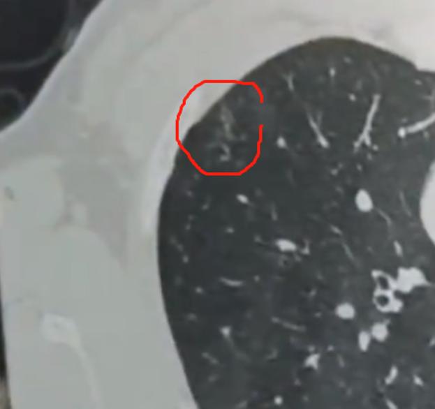 体检CT查出斑片影、淋巴结肿大，是肺癌吗？很多朋友体检做完胸部CT后，看到报告单