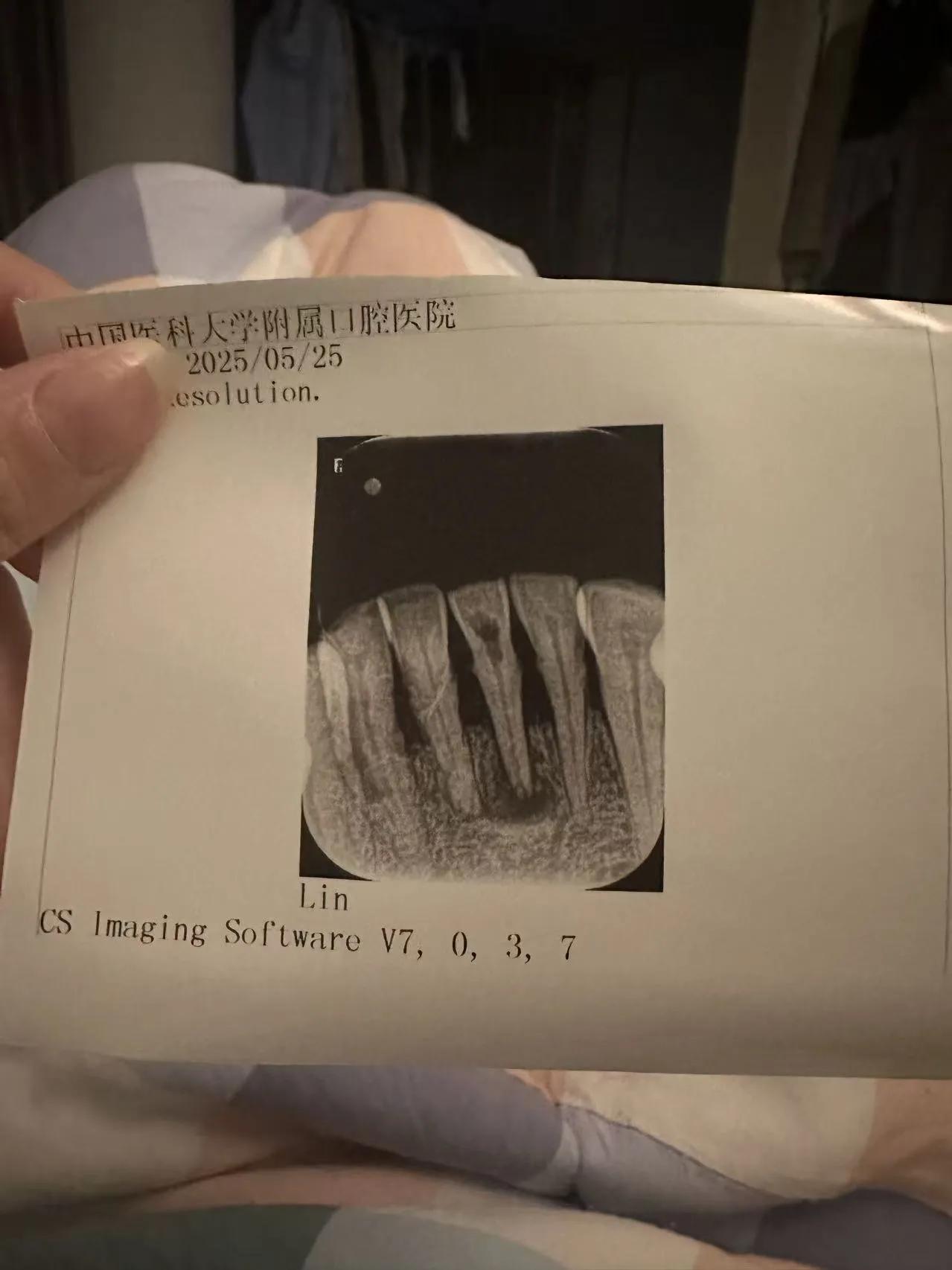 今天早餐后去中国医科大学附属口腔医院看牙。我这颗下门牙活动了，因为原来牙龈有炎症