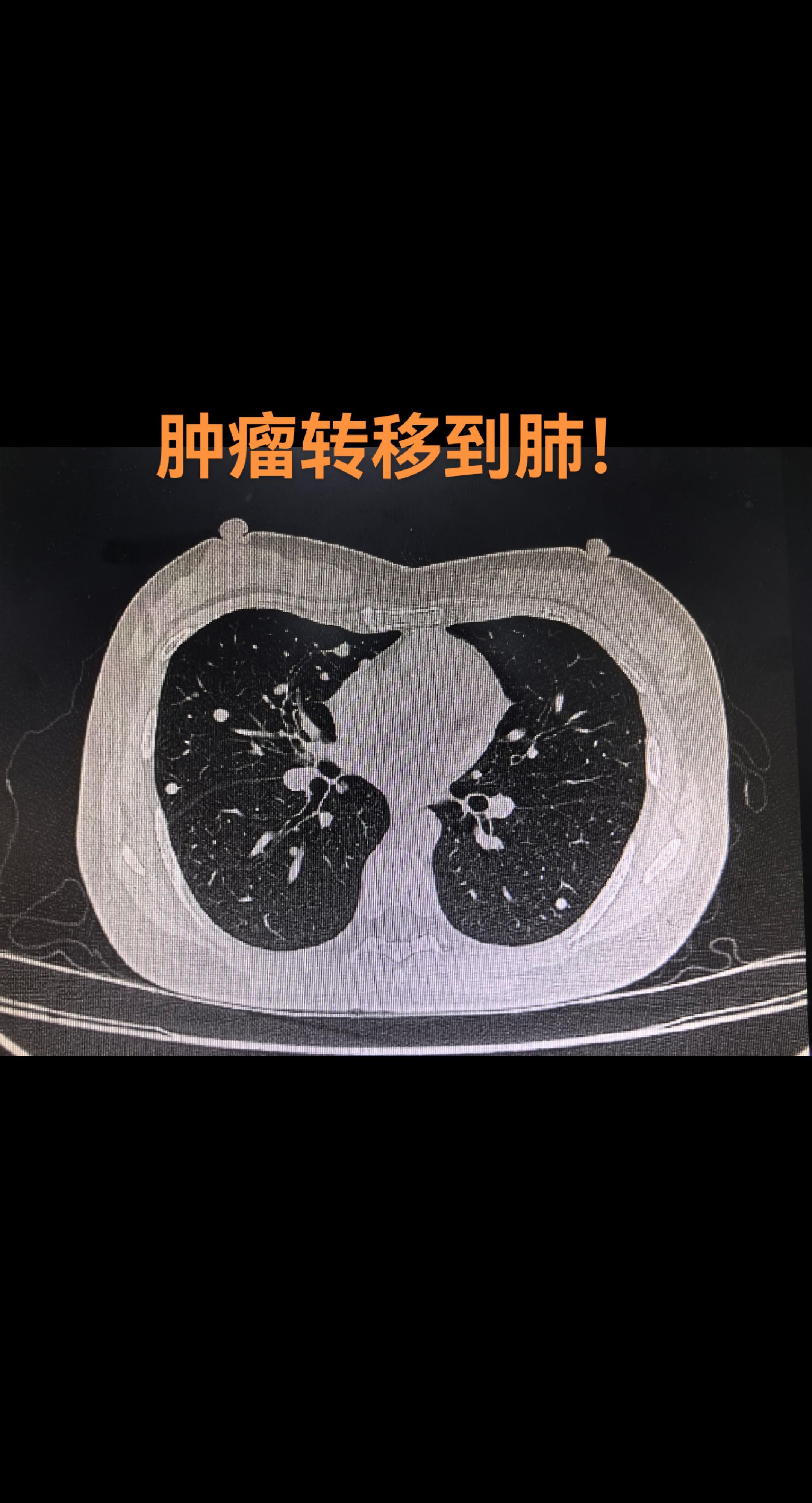 肿瘤转移到肺。