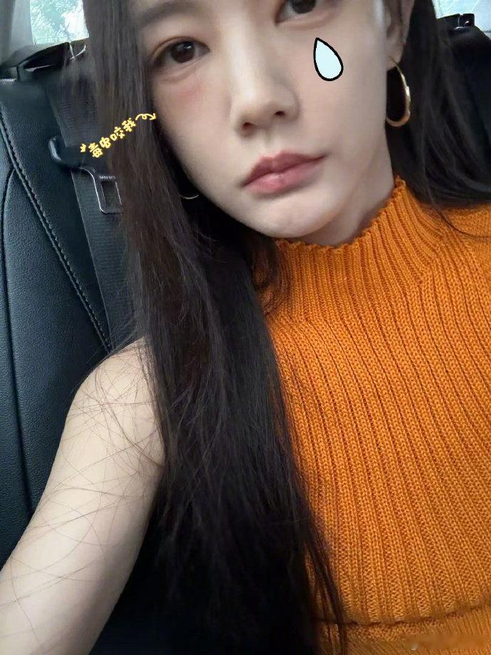 李一桐被毒虫咬了脸李一桐被毒虫咬了脸