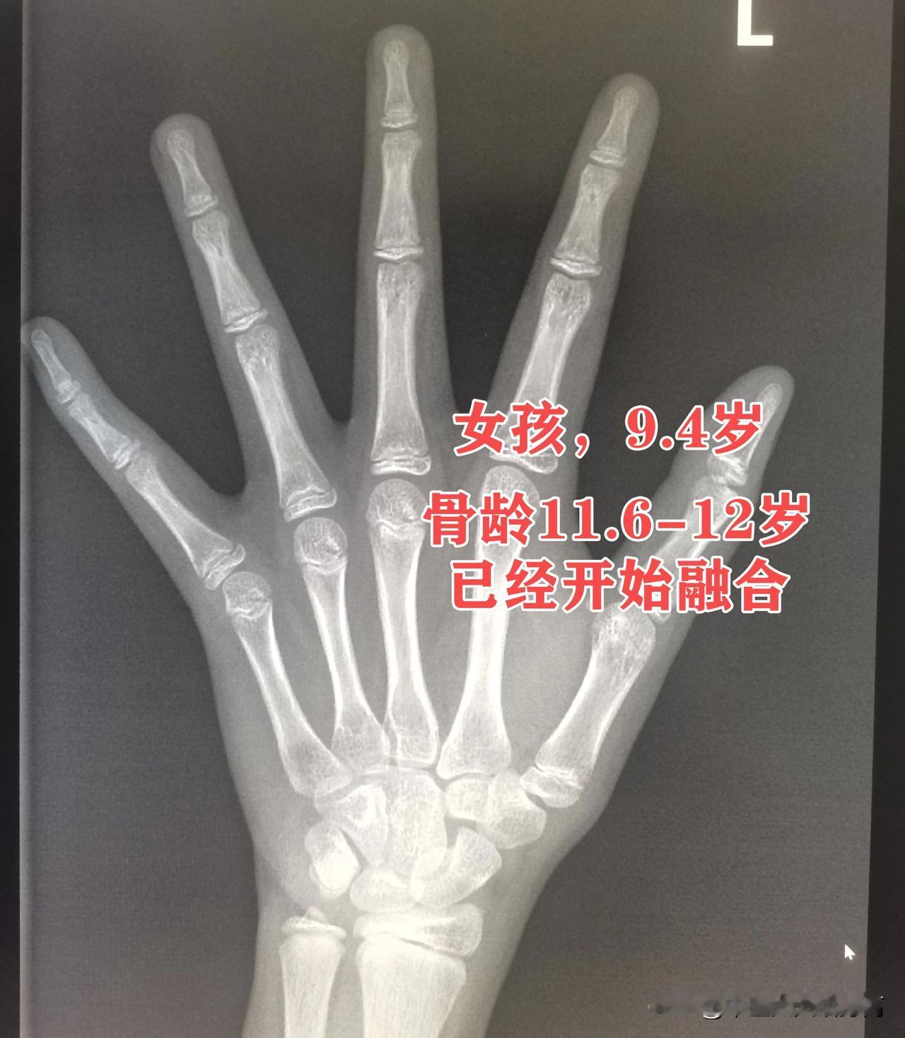 3个信号，提示你孩子骨骺线已接近闭合1.生长停滞如果孩子身高一整年几乎都没