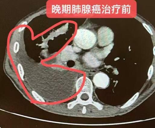 晚期肺腺癌，肿瘤几乎消失。男，66岁，肺腺癌，IV期，大量胸水，呼吸困...