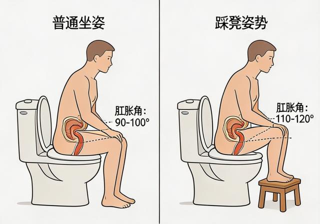 拉屎最快、最干净的1种姿势，很多人却不知道不少人蹲厕所十分钟半小时，用力憋得