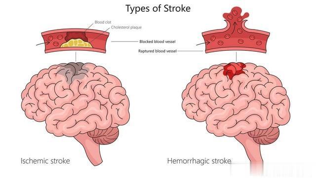 脑梗死患者能不能吃肉? 注意4点很关键