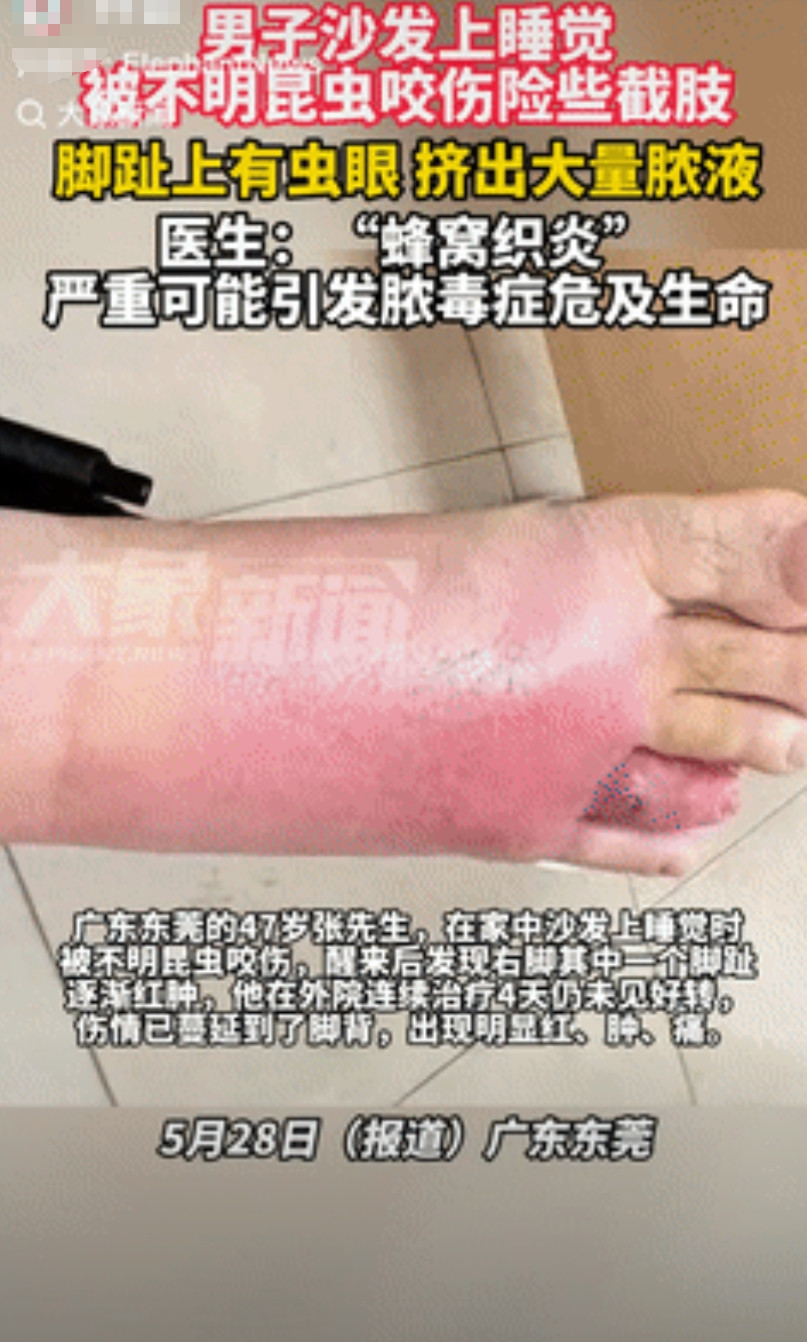 “不幸中的万幸！”5月28日，广东东莞，一47岁男子在沙发上睡觉时，被不明昆虫咬