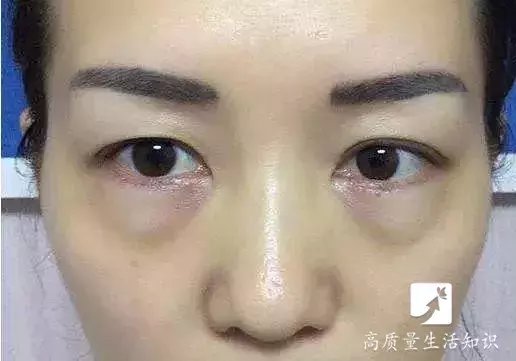 火龙果皮不要再扔了! 它是“眼袋”的克星