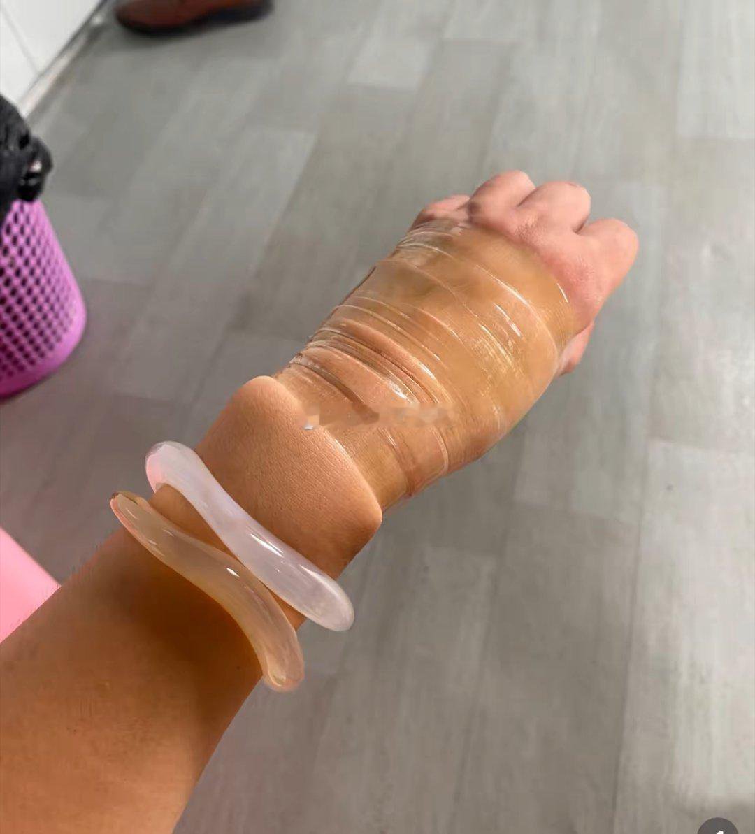 老妈的手镯取不下来了，该怎么办才好？