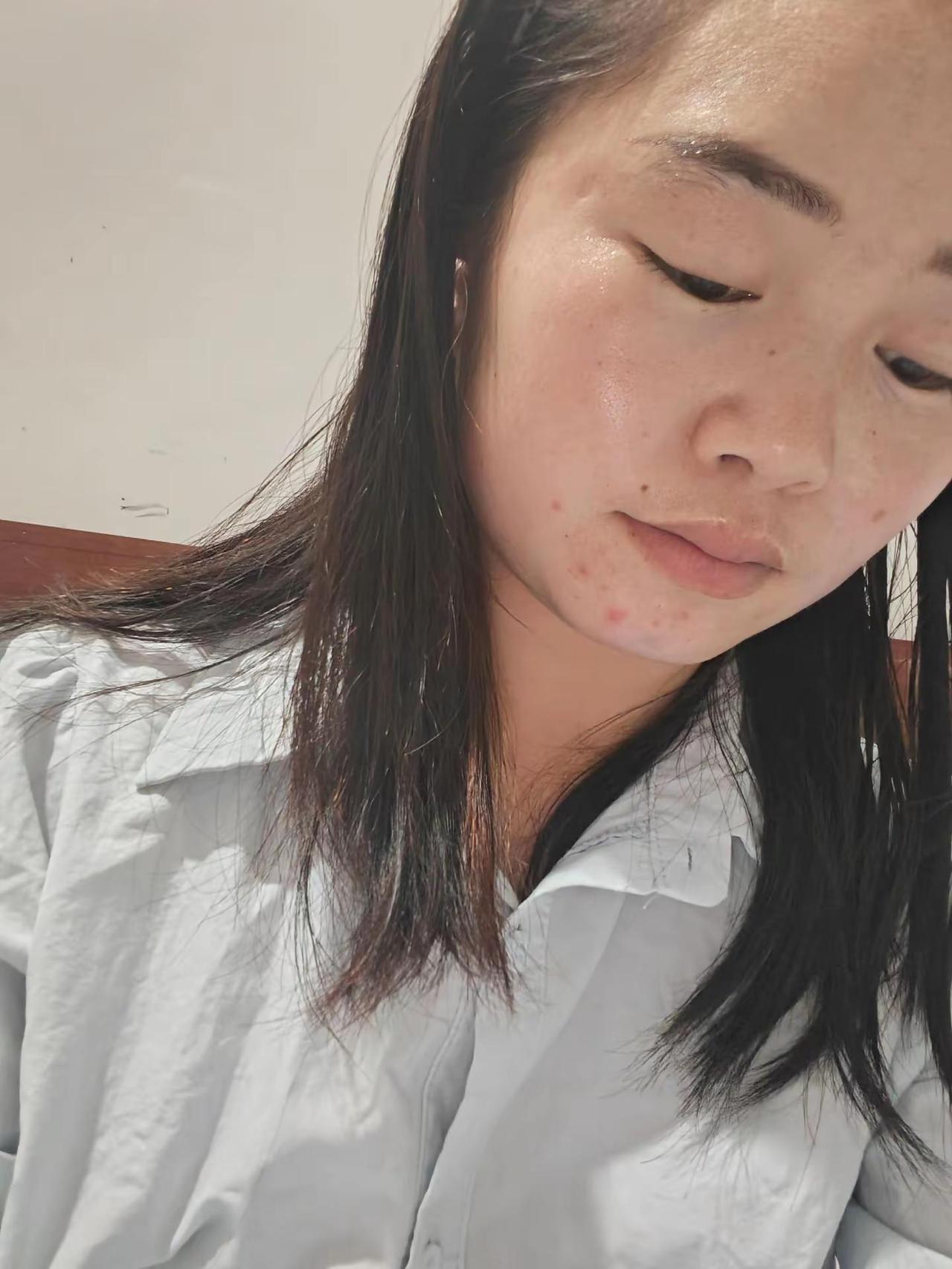 是不是缺男人啊？居然长痘了