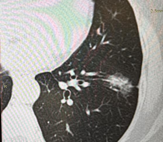 很多人看到病理报告上的“浸润性腺癌”会极度恐慌，误以为是绝症。其实浸润性腺癌完全