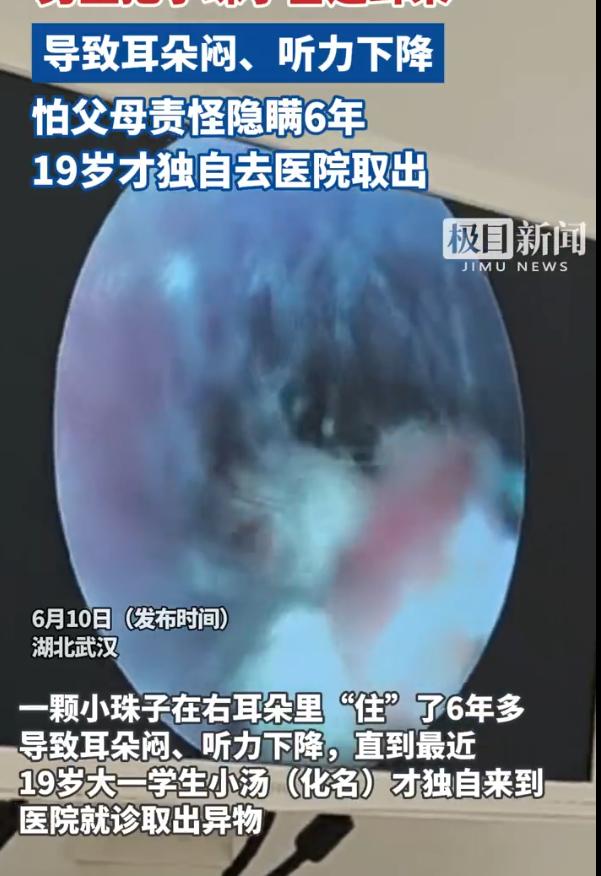 湖北，一名男生右耳持续闷堵、听力下降，去医院一查，医生竟从他耳道深处取出一颗黄豆