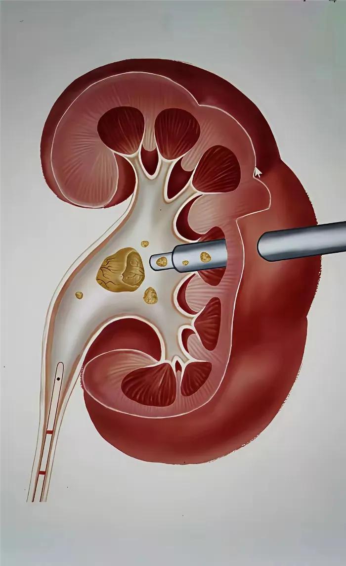 看着这图都肾疼，我不禁琢磨，要是有肾结石，最好别做这种手术。它是在肾上面打个洞，