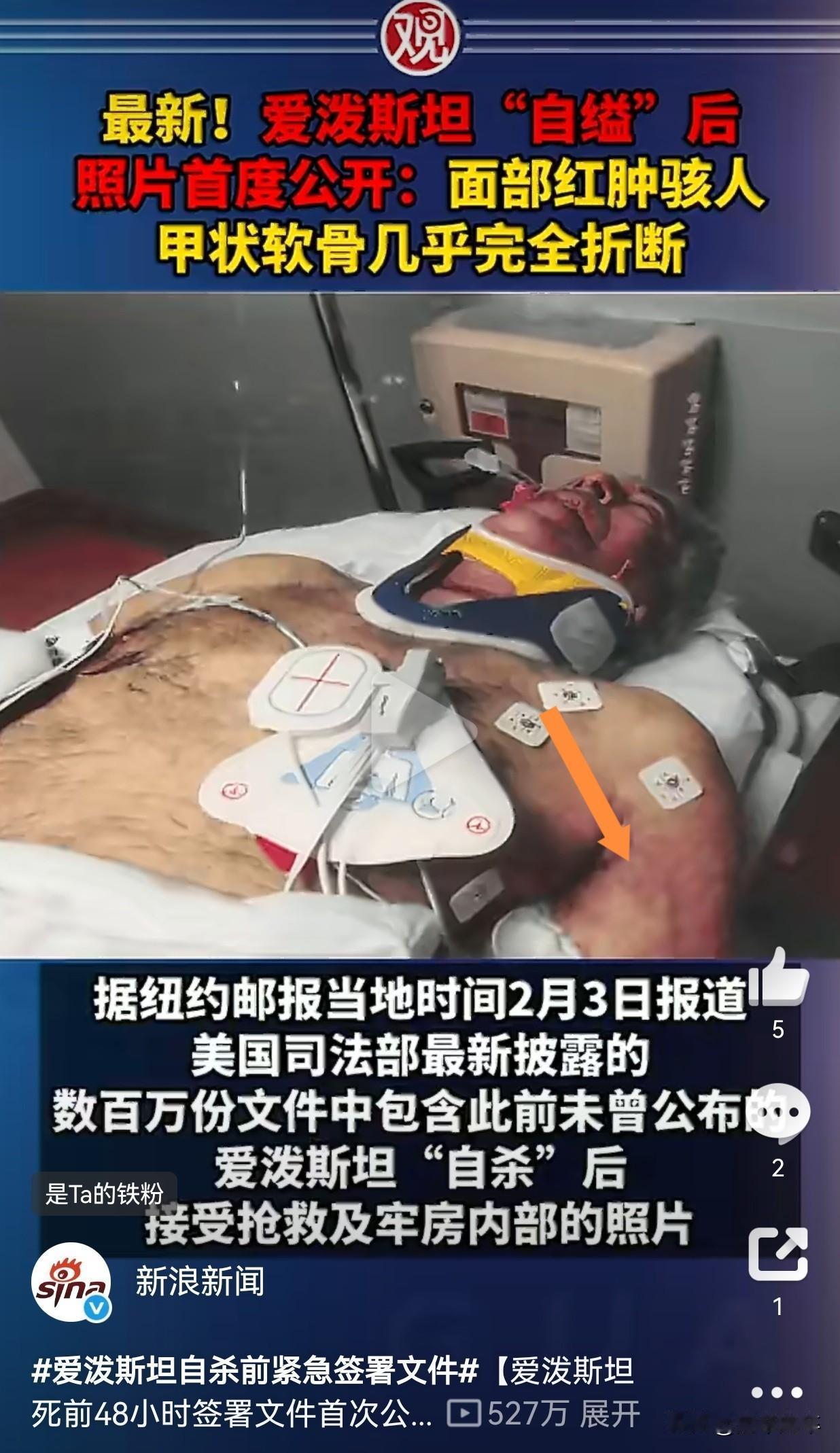 爱泼斯坦死亡成密了？今天有媒体公布了爱泼斯坦在狱中抢救的视频，却让人发现了一个