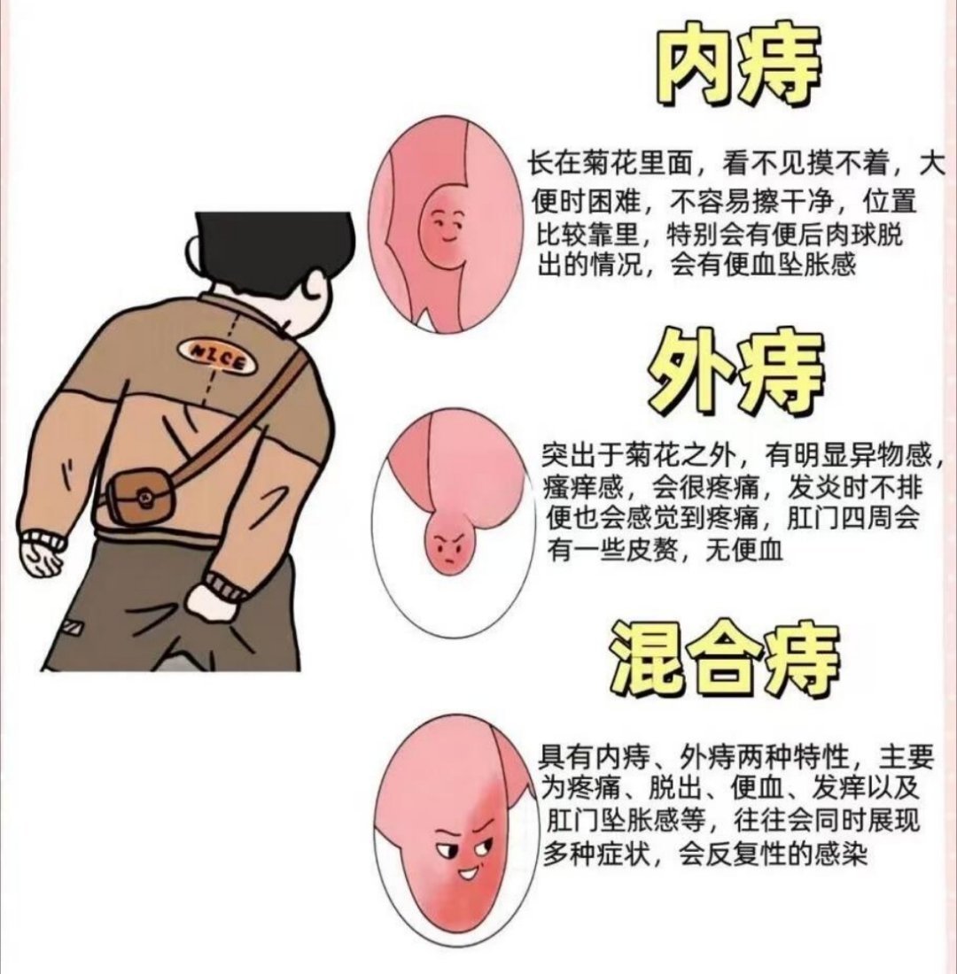 AI评割痔疮冲进临床最痛苦手术1秒自测，看看你是哪一种痔疮？上班久坐族，司机族