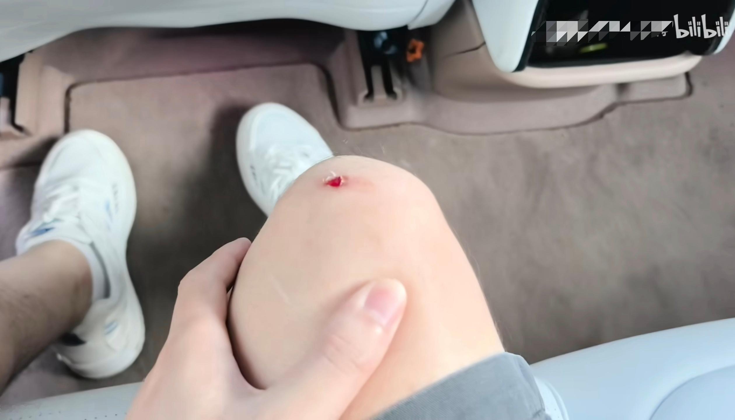 B站看到一位阿维塔车主分享的视频，下车的时候门板上的音响网罩把腿割破了[捂脸哭]车