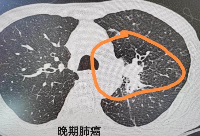 一提到肺癌，绝大多数人的第一反应都是“吸烟导致的”。但大家可能不知道，现在临床上