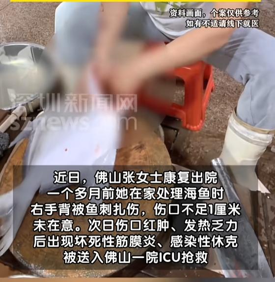 “悲剧还是发生了！”8月1日报道，广东佛山，一女子处理海鱼时，右手背被鱼刺扎伤，