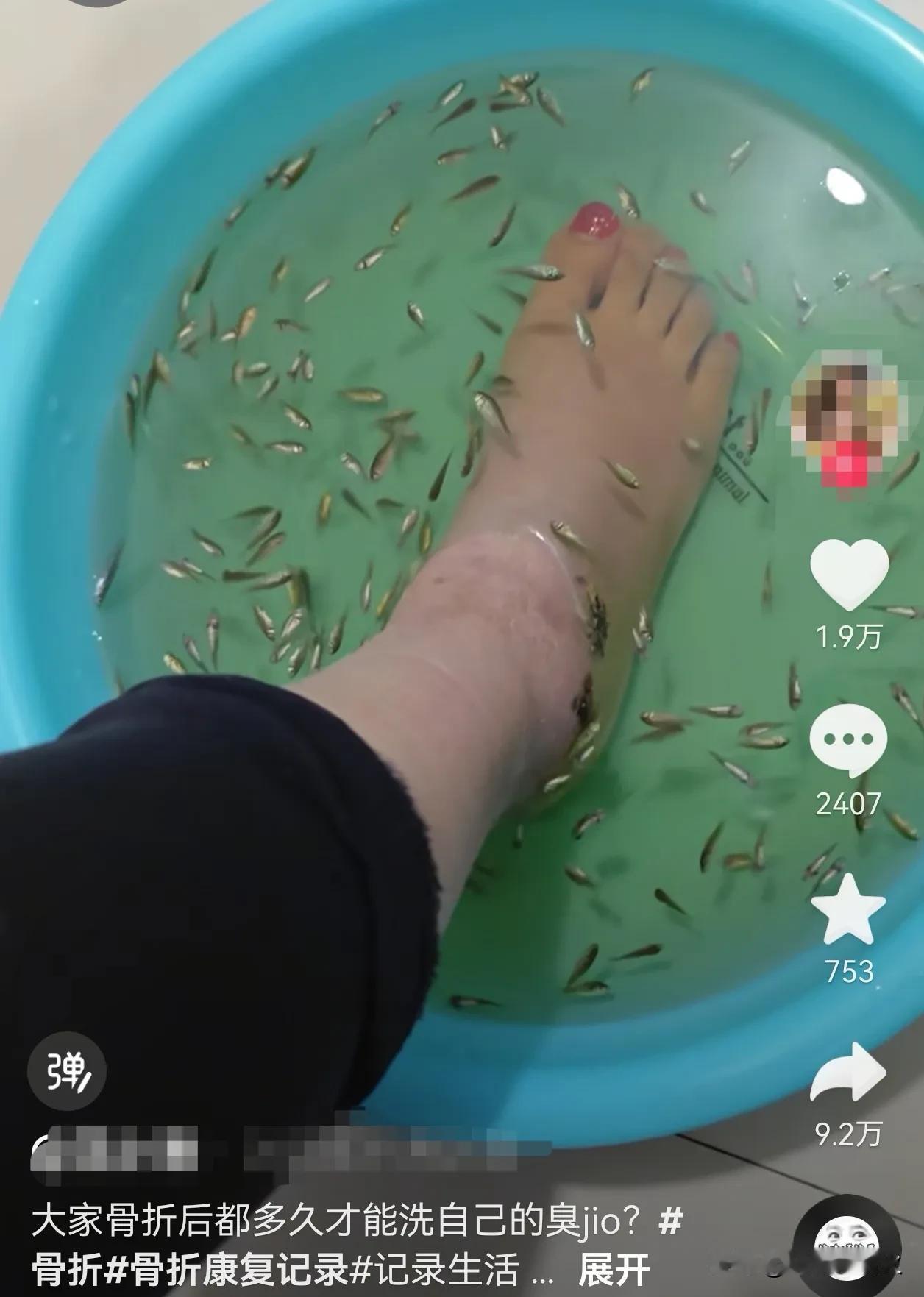 两个月没洗脚，连鱼都遭不住了！江苏，一女生外出的时候，不小心给脚摔骨折了，一