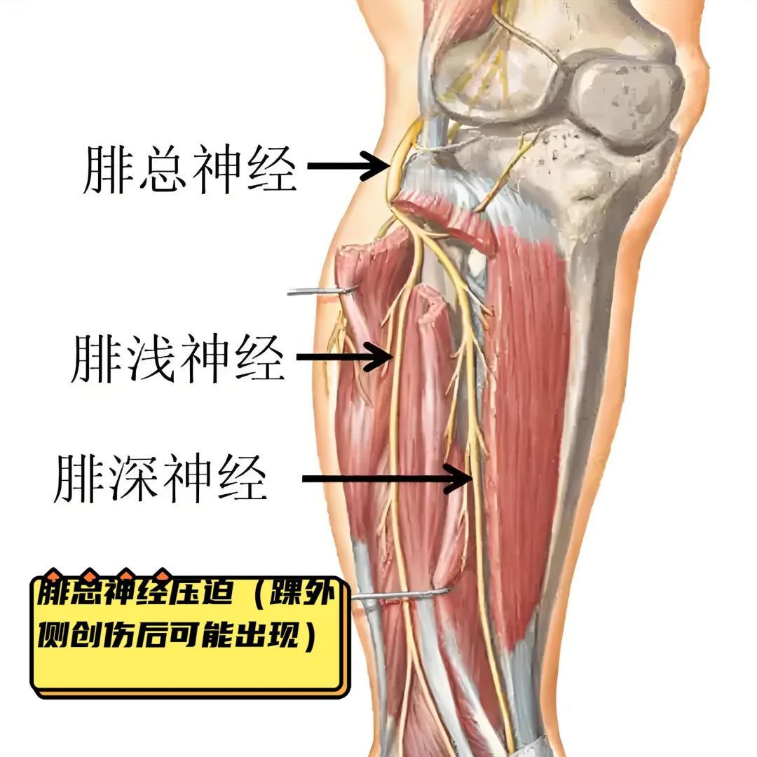 腓总神经损伤后遗症多？是你没找对锻炼的方向！关键是力量很多腓总神经损伤的患者