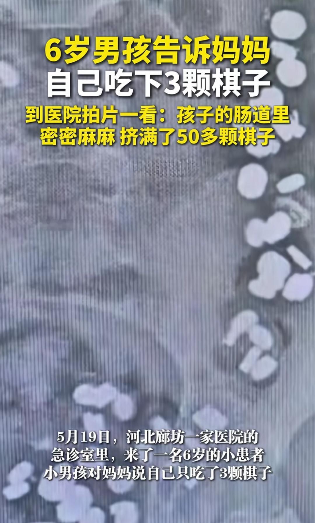 6岁孩子说吃了3颗棋子，一拍片竟然是50多颗。有个6岁的孩子告诉妈妈自己吃了3