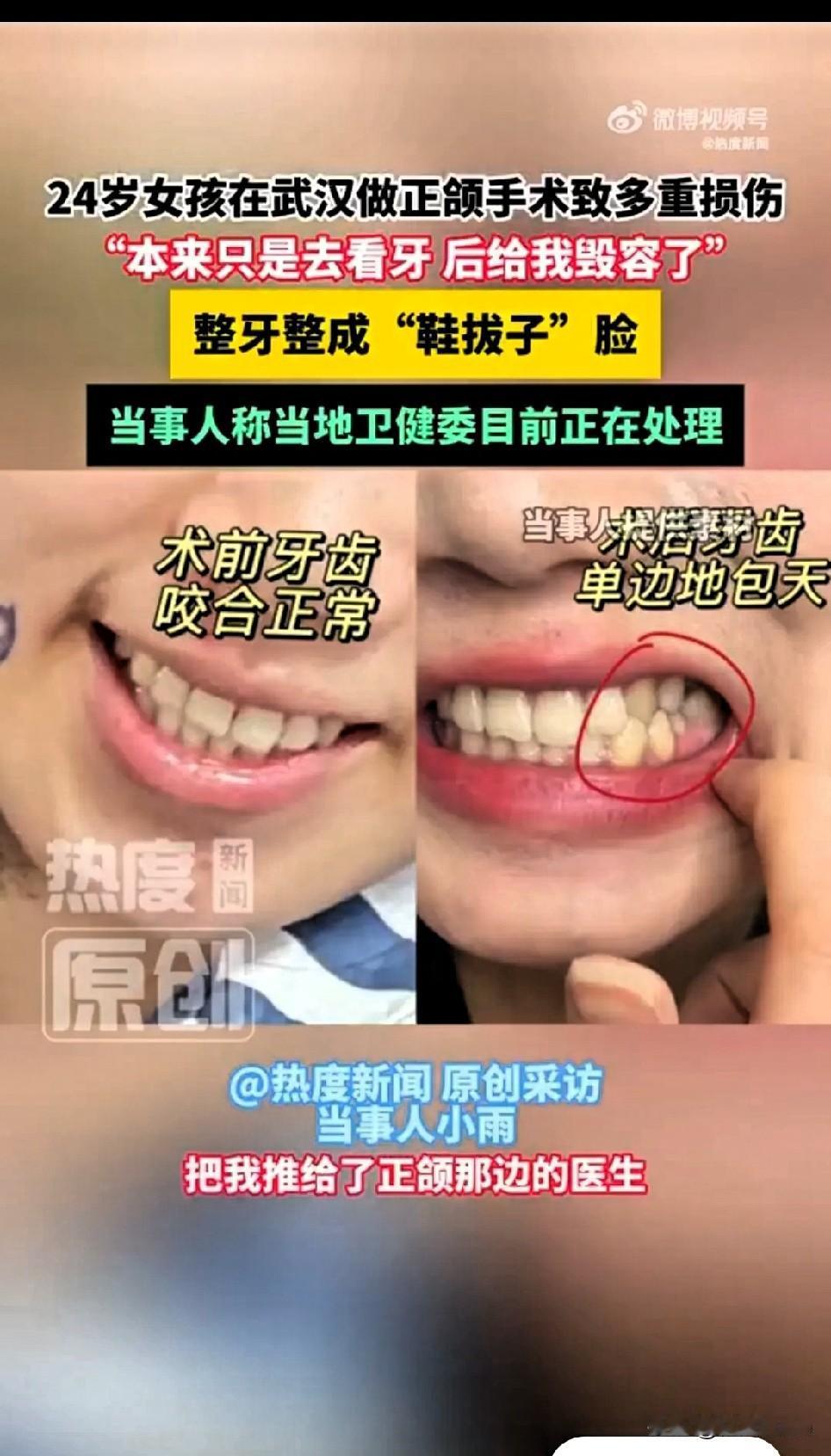 武汉那个“小雨姑娘”倒霉透顶。她本只想补牙、种牙，最多正畸，武大口腔医院医生却直
