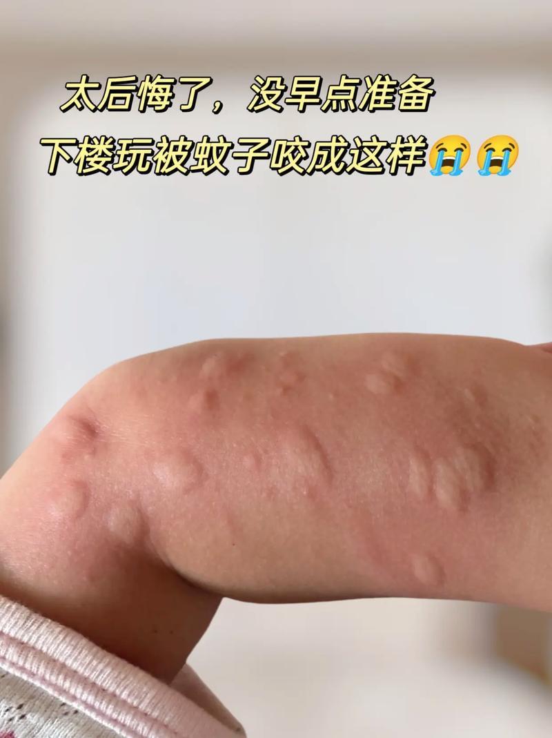 被蚊子叮咬后为啥会起肿包？实则是免疫系统在运作，蚊子叮人时，通过