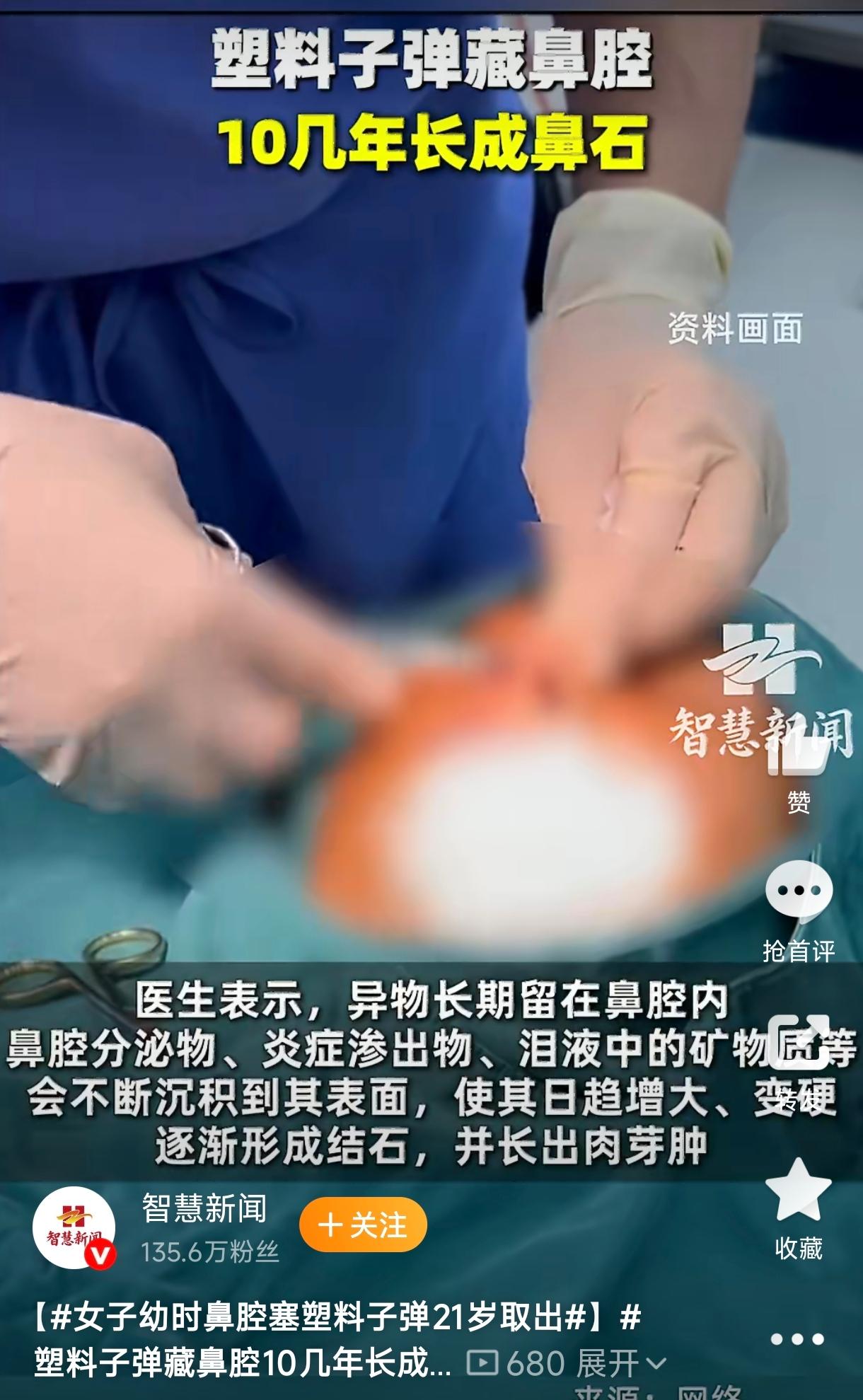 浙江杭州，一21岁女子多年来一直被右侧鼻腔流脓涕、异味困扰，最近半年鼻塞越来越重
