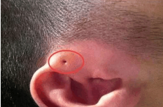 你家孩子耳朵上有这种孔吗? 有的话就要注意了