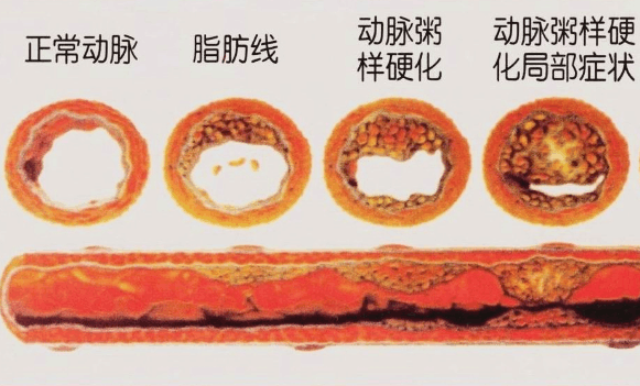 饮食治疗高血脂, 这样吃才对!