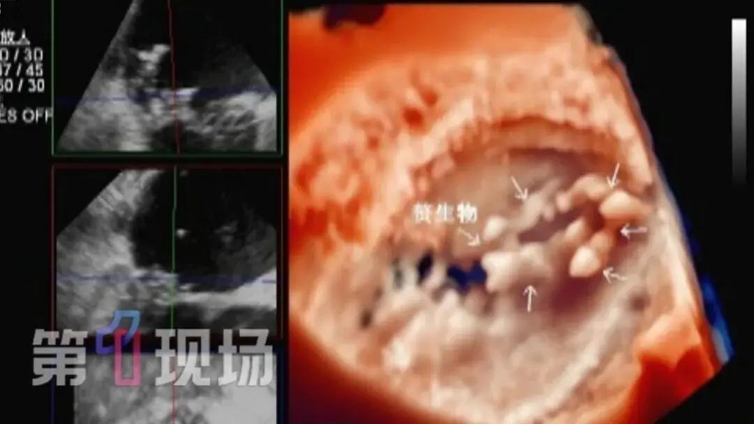 5月12日光明网报道，广东深圳一名51岁男子近几个月一直反复低烧，身体乏力，还明