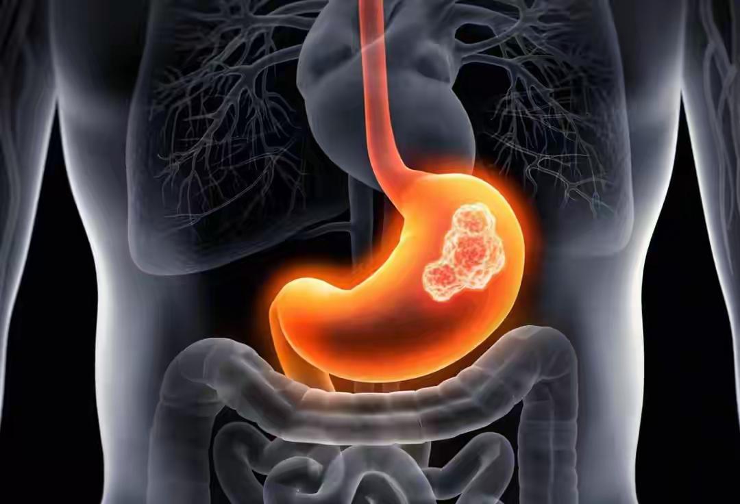 冐癌早期有哪些信号？这个问题关乎每个人的健康，因为很多癌症在早期就隐藏着“蛛丝马