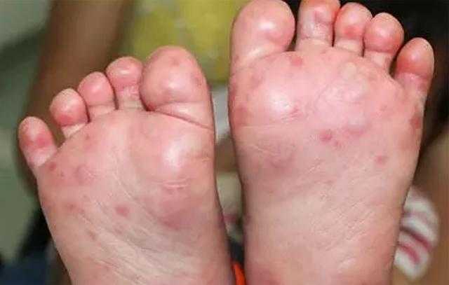 孩子手脚都是红疹, 宝妈担心虫子咬的, 医生安抚发现及时可治愈