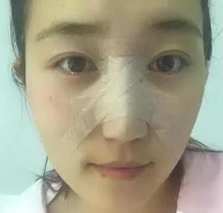 隆鼻后希望鼻子赶紧变秀气