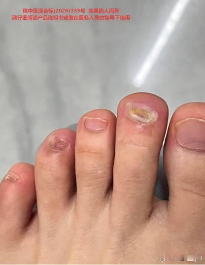 治不好的灰指甲，为什么医生对它不屑一顾？很多人疑惑，为什么在不少人眼里，灰