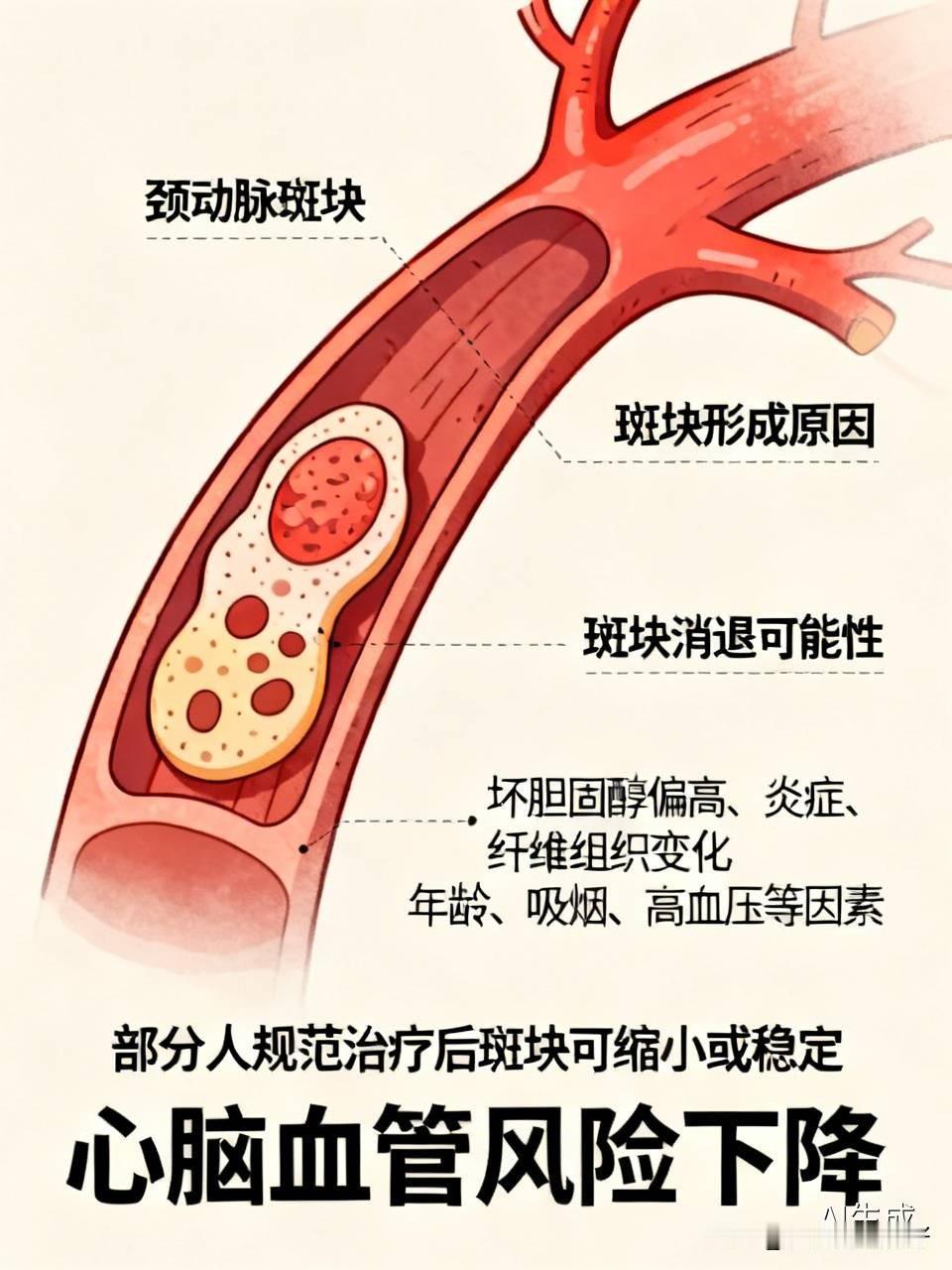 58岁张叔体检发现颈动脉斑块，吓得以为要脑梗。医生提醒：斑块不是判决书，关键看大