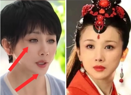 大家相信吗？孙菲菲说，她面容大变不是整容失败，是得了一种怪病名叫：库欣综合症