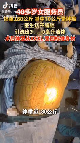 浙江，一女子180斤体重，但是减肥多年她的体重纹丝不动，没想到女子摔了一跤后，去