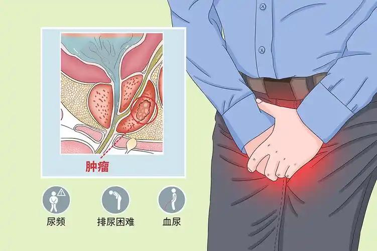 前列腺癌”是男性第二大肿瘤！医生：55岁后，这项检查能早发现 前列腺癌，盯上