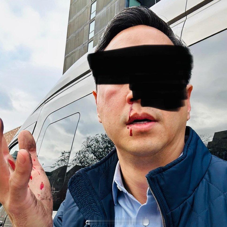 上周，一名45岁的亚裔美国男子在鲍厄里地铁站J线站台上遭到袭击，被人偷袭并摔倒在