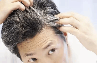 什么原因让头发变白? 后天性的白发, 主要有三个大方面