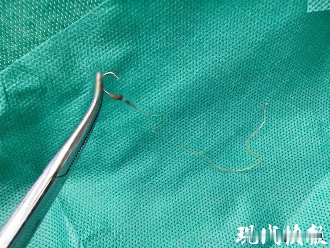 “简直不可思议！”江苏镇江，59岁女子肛门疼痛难忍，自己摸有一线头，拽一下痛得差