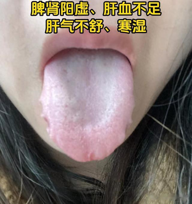 刘大夫舌象实战分析, 肾阳不足, 脾虚湿气重, 心火旺盛!