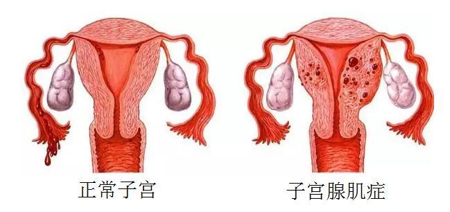 子宫腺肌病是怎么造成的?
