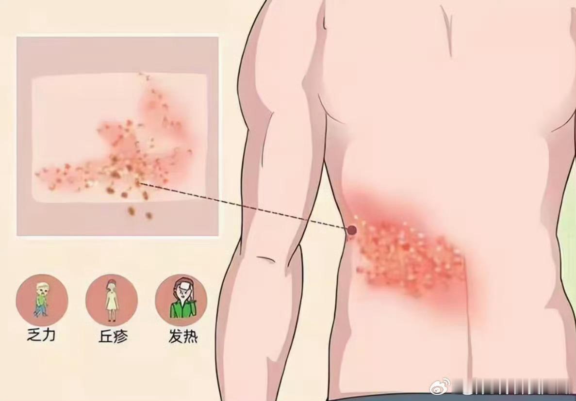 蔡依林自曝患蛇缠腰后才早睡大家一定要多多休息啊！这个病看起来真的好折磨！​​​