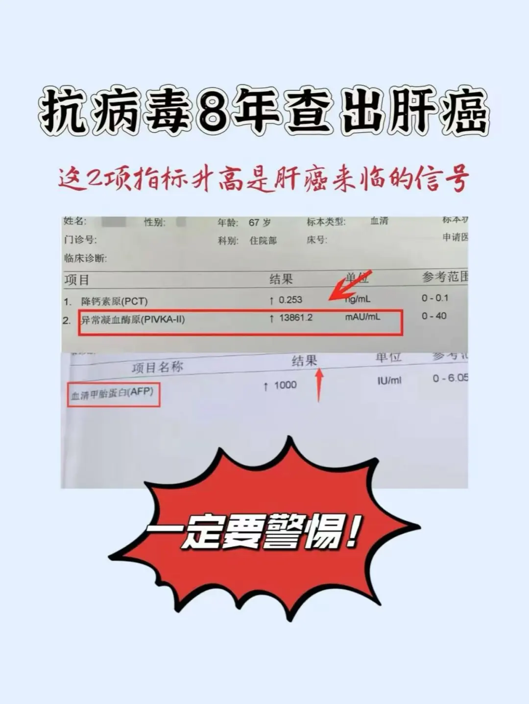 乙肝抗病毒8年查出肝癌，2个指标升高要警惕