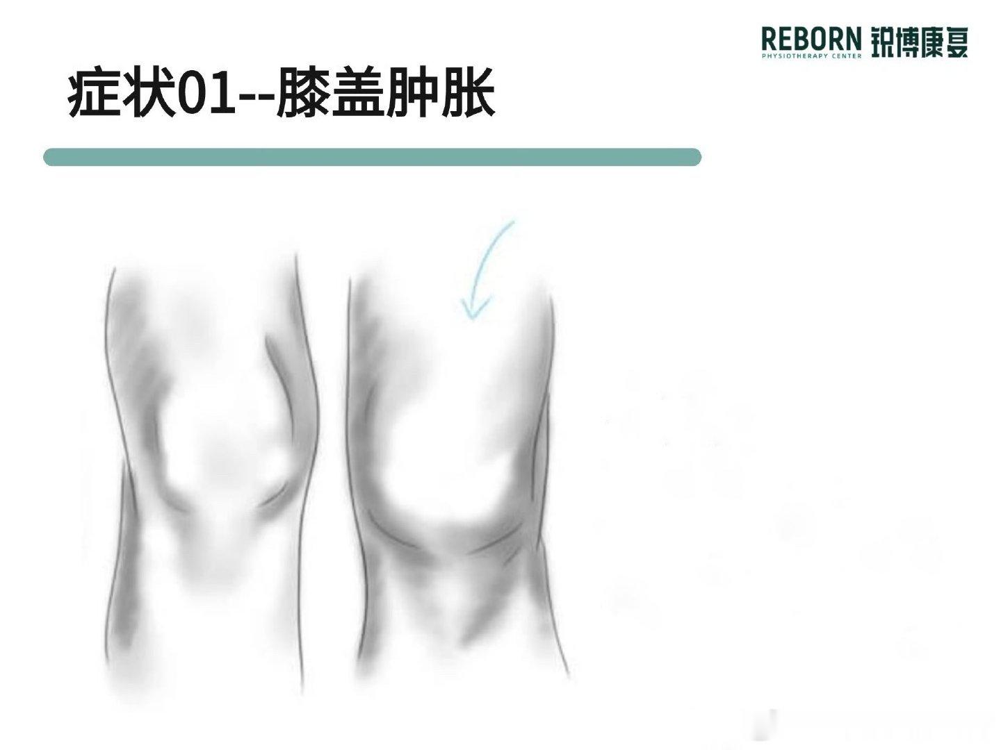 膝关节受伤后严重损伤的5个信号膝关节受伤后，如何判断受伤情况是不是很严重？ 1