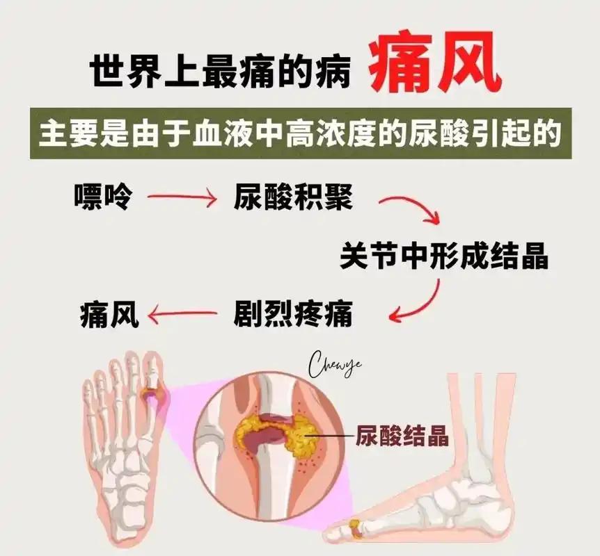 有个深圳的痛风患者，尿酸高了4年，平时都在539以上，总是感觉体内燥热，鼻孔冒热
