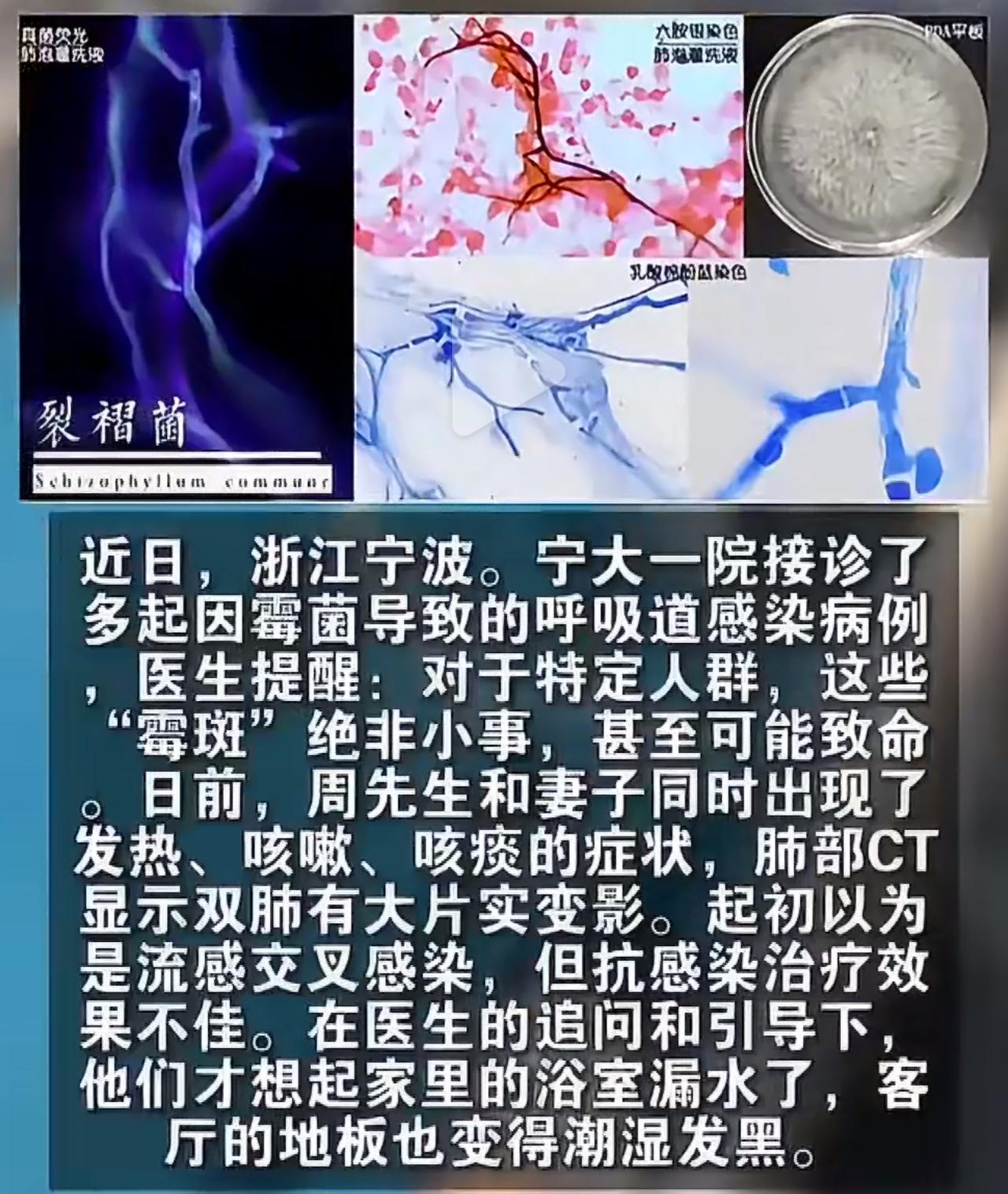夫妻二人接连发烧不停、总咳嗽有痰，做CT后发现肺部大面积出现阴影。最开始医生按普