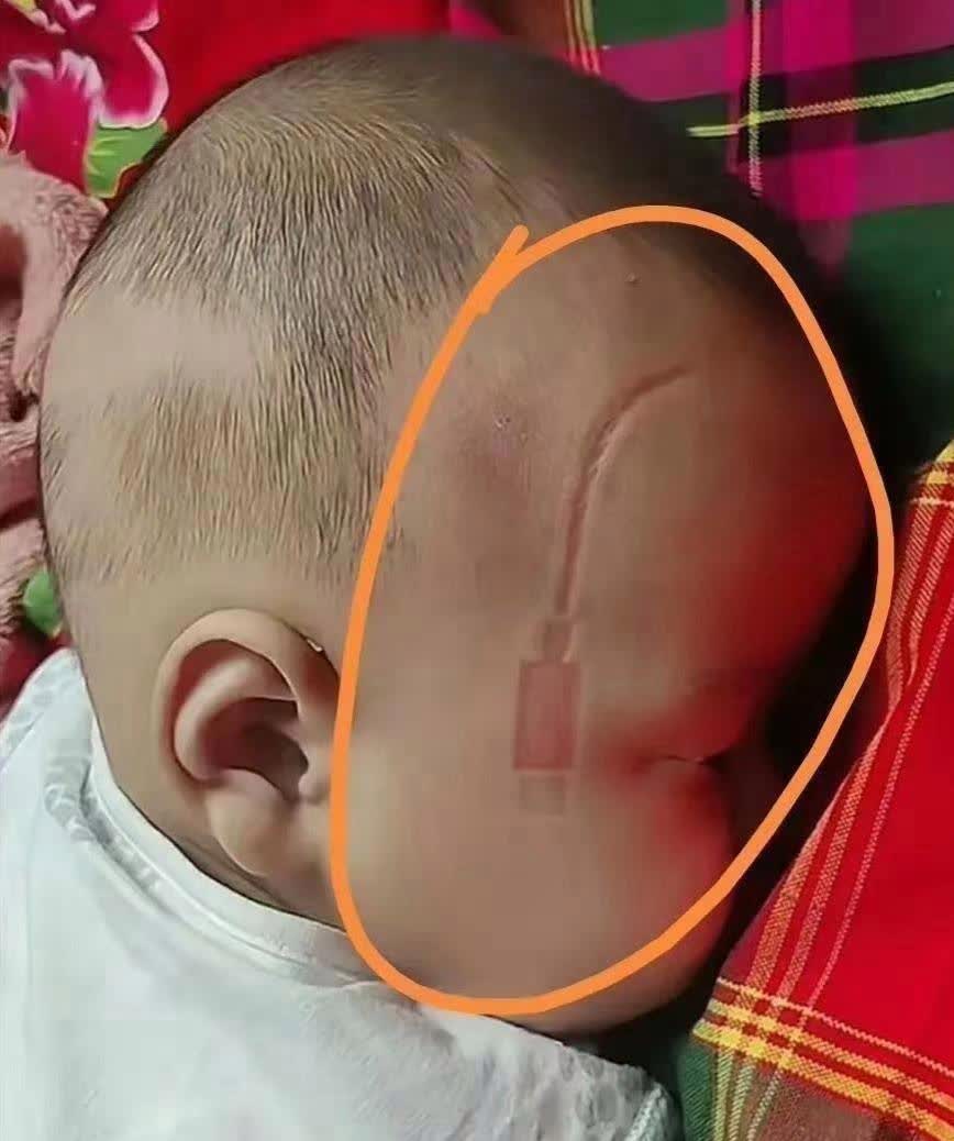 医生说，如果再多压三四个小时，这个充电器印子就永久性去不掉了，将会陪伴孩子一辈子