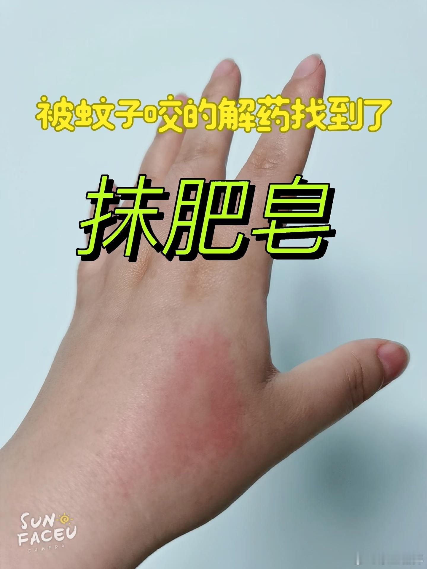 原来肥皂还能消肿止痒全能型选手肥皂