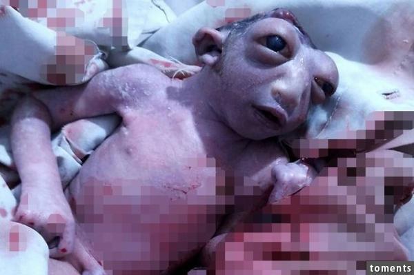 孕妇产下半颗头婴儿且眼晴像青蛙! 医生的解释让妈妈差点晕死!